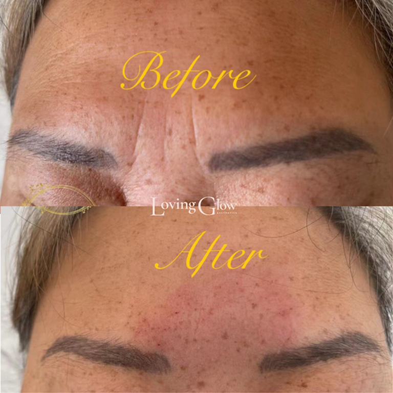 Before and after anti-wrinkle injections